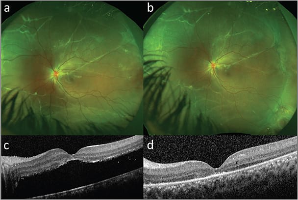 Figure 4. A 15-year-old female presented with 4 months of central vision loss following 4 years of progressive vision loss in the left eye after blunt trauma with a tennis ball. Her preoperative visual acuity was 20/500 with a near total macula-off detachment associated with extensive subretinal bands and multiple holes inferotemporally (without dialysis) (A, C). She underwent placement of an encircling 41-band covering the inferotemporal breaks with cryotherapy and drainage and was successfully reattached with resolution of the detachment 6 months postoperatively. Postoperative OCT revealed persistent subfoveal outer retinal loss due to the chronicity of the retinal detachment (B, D).