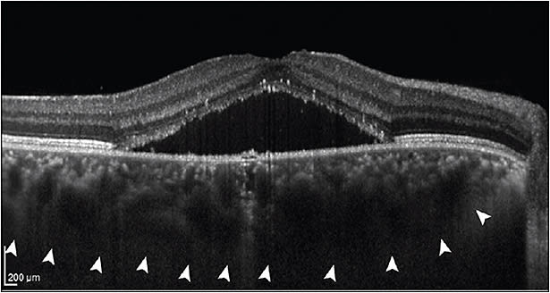 Figure 5. Central serous chorioretinopathy with serous detachment of the retina centrally demonstrating markedly thickened choroid (arrow heads). Image reprinted with permission from https://commons.wikimedia.org/wiki/File:Central_serous_chorioretinopathy_with_increased_choroidal_thickness.png.