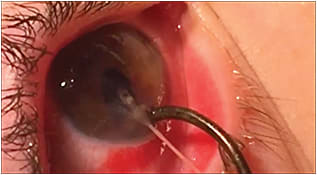 Figure 7. Photo demonstrating fish hook foreign body traversing the cornea into the anterior chamber.