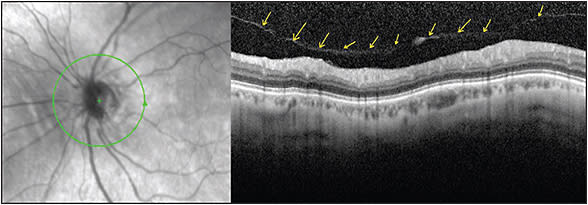 Figure 4. A Weiss ring was not visible on examination in this eye; however, on OCT imaging a line is visible (arrows), indicating posterior hyaloid still attached to the ONH.
