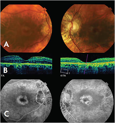 Figure 4. This 78-year-old male was referred with a one- year history of progressive, bilateral central blurring. VA measured 20/40 RE and count fingers LE. Fundus examination revealed bilateral generalized RPE atrophy with optic nerve pallor LE, and FA demonstrated staining in a bull’s eye pattern (Figures A and C). Macular OCT identified bilateral outer retinal and RPE atrophy, and an epiretinal membrane RE (Figure B). The patient denied a history of hydroxychloroquine or chloroquine use. Cone-rod dystrophy was suspected and then confirmed when ERG showed a broadly diminished wave-form that was worse under photopic conditions.