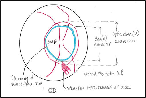 Figure 2. Splinter hemorrhage of disc, 92202.