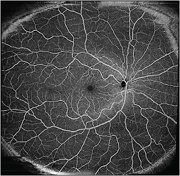 Figure 1. Montage of 12 mm x 12 mm scans from a normal eye obtained on the swept-source Zeiss Plex Elite 9000. Five 12 mm x 12 mm scans were obtained, one centered at the fovea, and the other 4 centered at the 4 quadrants around the fovea. The montaging of these 5 scans, by the Zeiss proprietary software, allows for visualization of a wider retinal field of view than that allowed by individual OCTA scan protocols.