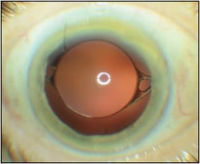 Figure 2.  Postoperative week 4 with an excellent uncorrected visual outcome. 
IMAGE COURTESY OMESH GUPTA MD, MBA