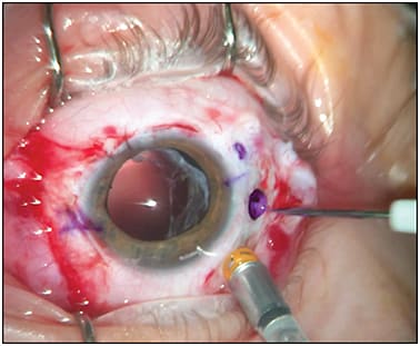 Figure 3. Creating 2 sclerotomies at the 3 o’clock position with a 23-gauge trocar, 2 mm posterior to the limbus. Each sclerotomy is 2mm to 3 mm from the midpoint line and marked with a purple marking pen to make it easier to find later.