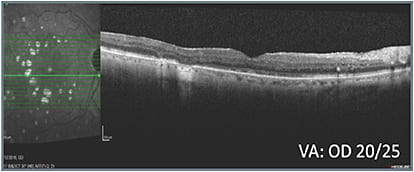 C: Status 12 weeks after treatment class switch OD
