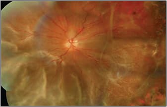 Figure 1. In this eye with complete rhegmatogenous retinal detachment after failed surgery in the presence of preretinal and subretinal PVR, failed laser demarcation can be noted to the right. Anatomic success in this case required scleral buckle, extensive membrane peeling, and silicone oil tamponade.