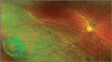 Figure 1. Chronic inferior macula-involving “retinogenic” rhegmatogenous retinal detachment, right eye, associated with peripheral retinal lattice degeneration with atrophic holes, inferior-temporal midperipheral retinal macrocyst and multiple (sequential) demarcation lines (“high water marks”). Because there is no posterior vitreous detachment or horseshoe retinal tear under traction in this phakic eye of a young patient, a scleral buckle procedure would be the primary treatment consideration for this inferior retinal detachment.