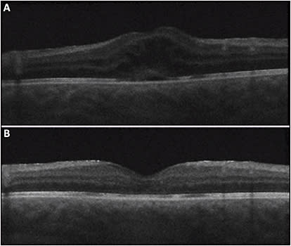 Figure 2. A 9-year-old male with pars planitis and persistent macular edema in the right eye (A) which resolved 4 weeks after subtenon injection of 40 mg triamcinolone (B). 
COURTESY OF AJAY E. KURIYAN, MD, MS.