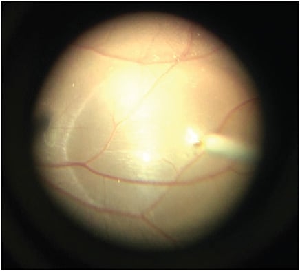 Figure 1. Subretinal bleb injection without pre-bleb.