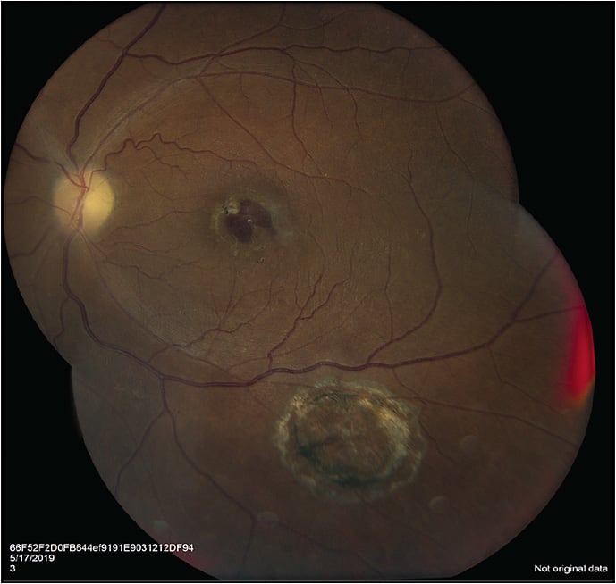 Figure 3. Fundus photo 2 months after retinal patch graft surgery in a 64-year-old male.