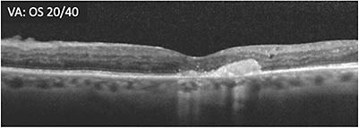 E: Status post switch to different class of therapy. Initial VA outcome was 20/63 -2, eventually stabilizing at 20/40 with continued treatment.