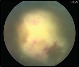Figure 1. Fundus photo of a 61-year-old patient with a history of systemic large-cell lymphoma more than 15 years prior to presentation. Polymerase chain reaction testing of the aqueous humor was negative for VZV, CMV, HSV, and toxoplasmosis. Diagnostic pars plana vitrectomy showed large-cell lymphoma, establishing a diagnosis of secondary vitreoretinal lymphoma.8