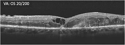 B: Three months after last treatment with initial therapy