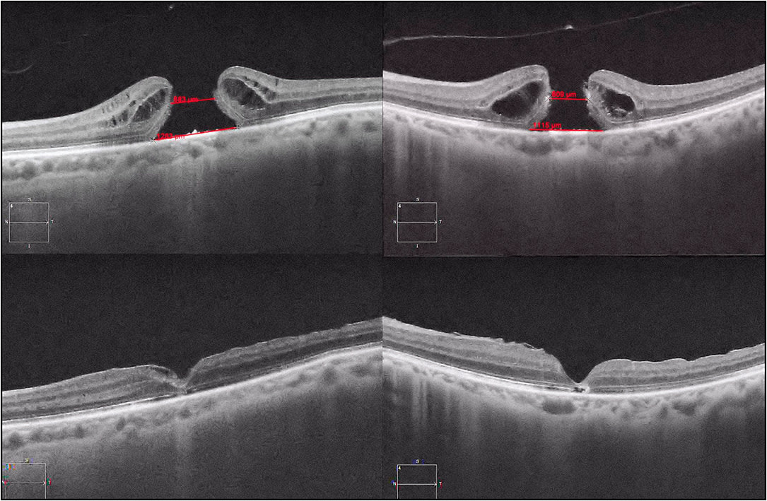 Figure 1. Optical coherence tomography (OCT) appearance of preoperative (top) and corresponding postoperative (bottom) cases of “giant” macular holes closed by the modified inverted internal limiting membrane flap technique. With close inspection, the flap can be seen over the macular hole on the postoperative OCT. The red lines in the preoperative photos indicate the minimum linear diameters (683 and 609 µm) and basal diameters (1283 and 115 µm) of the macular holes.