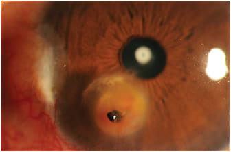 Figure 1. Intraocular foreign body through the cornea and into the anterior chamber.
