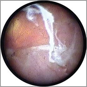 Figure 4. Endoscopic view of extensive subretinal membrane after forceps extraction from subretinal space. The retina is now highly mobile.