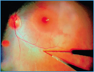 Figure 2. Surgeon’s view of patient’s right eye illustrating the recommended site of subretinal injection along the superotemporal arcade at least 2 mm away from the foveal center, avoiding major vessels or areas of pathologic changes.
Courtesy of Tahira Scholle, MD, and J. Timothy Stout, MD, MBA, PhD, Baylor College of Medicine
