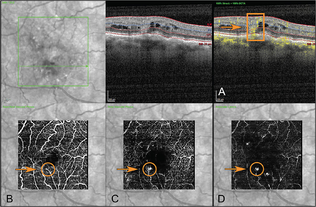 Figure 2. OCTA showing a retinal angiomatous proliferation (RAP) lesion. OCT B scan demonstrating flow (yellow) signal traversing the depth of the entire retina within the orange rectangle (A); OCTA en face images show the RAP lesion within the orange circle in the superficial, deep, and avascular segments of the retina, respectively (B-D).