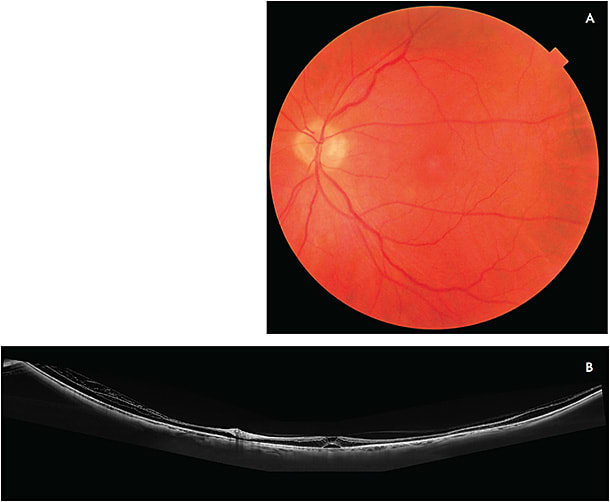 Figure 1. Images from a 43-year-old woman referred for prerefractive surgery evaluation. Color photograph of the left eye (A). Swept-source OCT montage (DRI OCT Triton; Topcon) demonstrating myopic schisis extending outside the macula involving both the inner and outer retina (B).