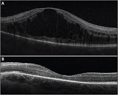 Figure 1. A 29-year-old female with bilateral pars planitis, with recurrent severe macular edema in the left eye (A) which resolved 1 month after starting difluprednate twice daily (B).
COURTESY OF ANGELA BESSETTE, MD.