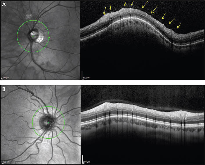 Figure 1. The line (arrows) represents the posterior hyaloid that is still attached to the ONH.