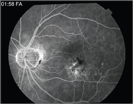 Figure 1. Fluorescein angiogram of the left eye of a 72-year-old female, revealing a mixed classic and occult choroidal neovascular membrane inferior to the fovea.