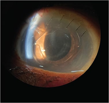 Figure 2. Postoperative image of anterior-chamber intraocular lens.
