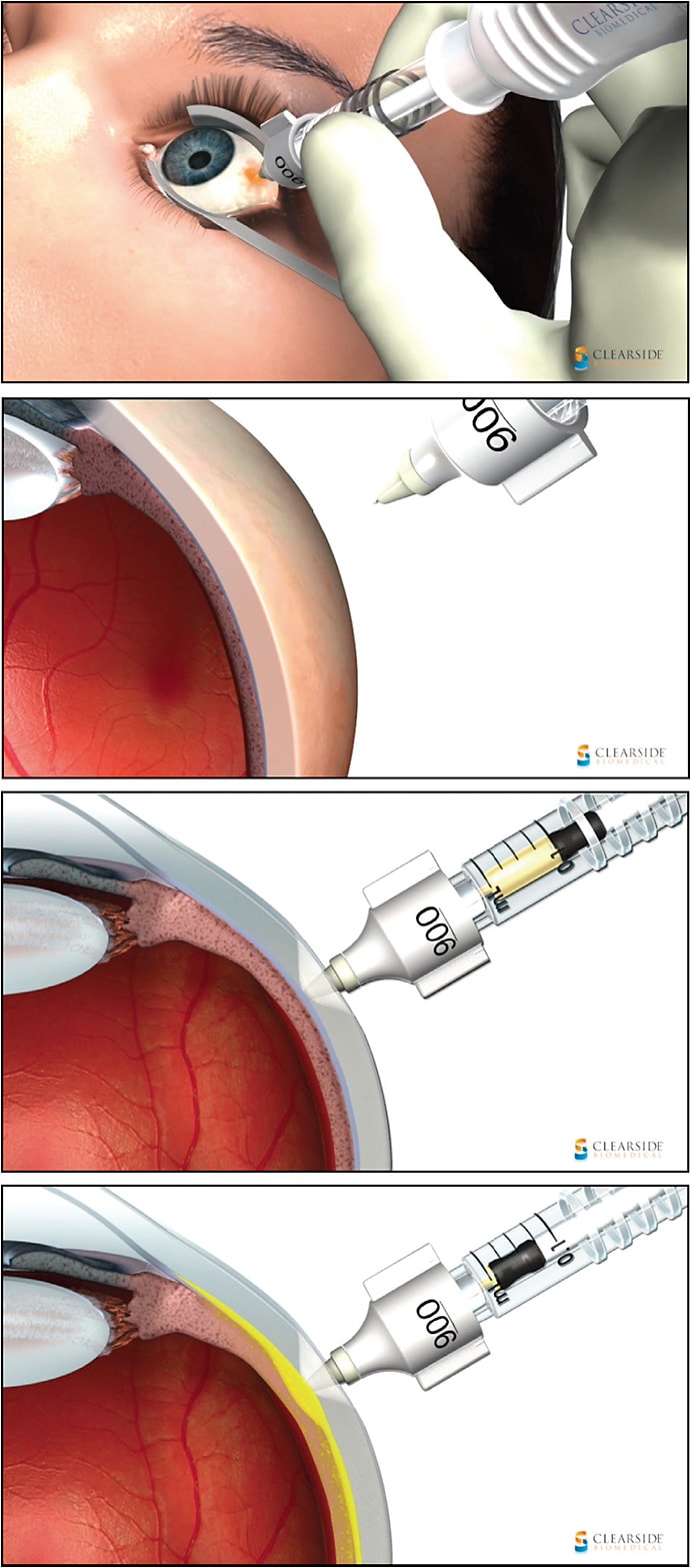 Figure 1. The injection procedure differs from an intravitreal injection in that the microneedle length requires insertion that is both perpendicular to the sclera and complete (to the hub) (A, B). Gentle pressure is maintained on the plunger throughout insertion, triggering the release of the TA only once the needle passes the dense sclera and reaches the correct, lower resistance potential space (C, D).