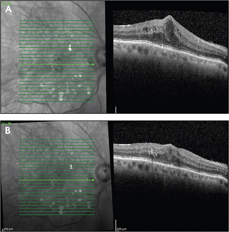 Figure 3. A 75-year-old female with type 2 diabetes mellitus presented for scheduled follow-up. She had chronic visual loss despite a series of aflibercept injections. BCVA was 20/40 OD. SD-OCT OD revealed center-involved diabetic macular edema, and CST was 479 µm (A). The patient was counselled regarding the importance of optimal control of blood glucose, serum lipids, and blood pressure and was treated with the dexamethasone delivery system. The patient returned for follow-up 1 month later. She noted improved vision OD, although BCVA remained 20/40 OD; SD-OCT demonstrated improved macular edema; and CST improved to 362 µm (B).