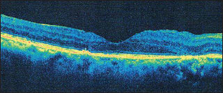 Figure 4. Three weeks post-treatment, the patient from Figure3 had central retinal thickness decrease to 159 μm, and visual acuity improved to 20/50 from 20/60.