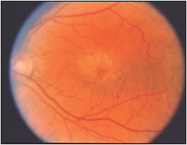 Figure 2. Grade 2 NCMD in a 37-year-old female with confluent drusen and 20/20 visual acuity.