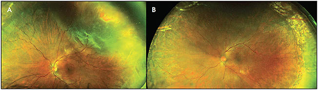 Figure 1. Rhegmatogenous retinal detachment left eye, extending from the 11:30 to the 5:00 meridian, associated with superotemporal and temporal peripheral horseshoe tears in the vitreous base region (A). Postsurgical (primary pars plana vitrectomy) Optos ultrawidefield fundus photographic view showing successful reattachment and peripheral retinal laserpexy for 360 degrees (B).