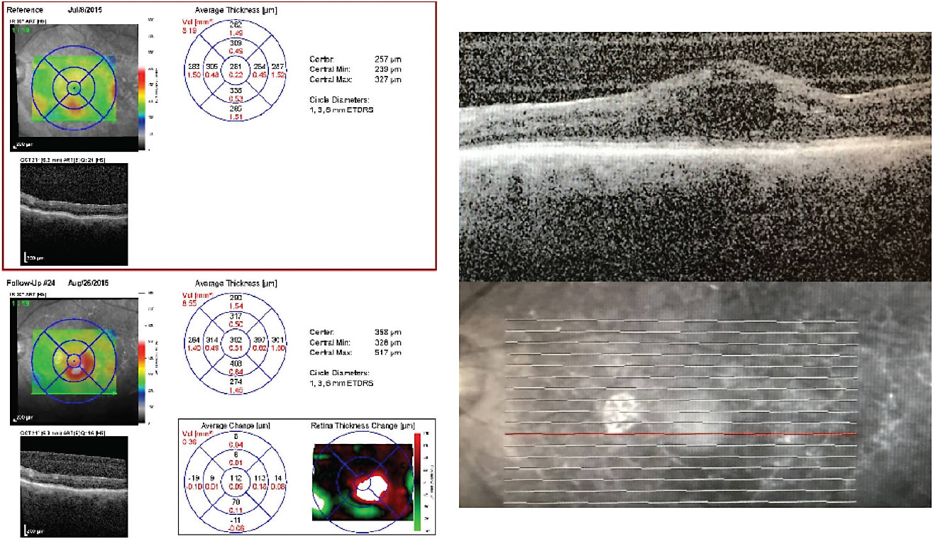 Figure 2. When a second dexamethasone intravitreal implant OS was no longer having an effect, the DME recurred and Iluvien was implanted.