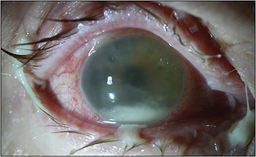 Figure 1. Slit-lamp photograph of a patient with acute-onset endophthalmitis demonstrating cloudy cornea, layered hypopyon, and fibrin in the anterior chamber. Retinal detachment can also be present.