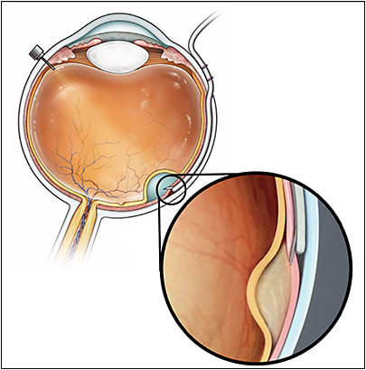 Figure 2. Access to the subretinal space may be achieved using a catheter in the suprachoroidal space. The Orbit Subretinal Delivery System (Orbit SDS; Gyroscope Therapeutics), pictured here, is designed to avoid the need for a vitrectomy and perforation of the retina by using a suprachoroidal approach. When the suprachoroidal catheter is in the desired position, a microneedle is advanced by the surgeon to access the subretinal space. 
IMAGE COURTESY OF GYROSCOPE THERAPEUTICS