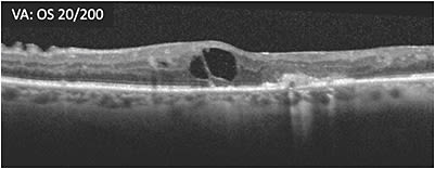 C: Four weeks after first treatment with second therapy within same class