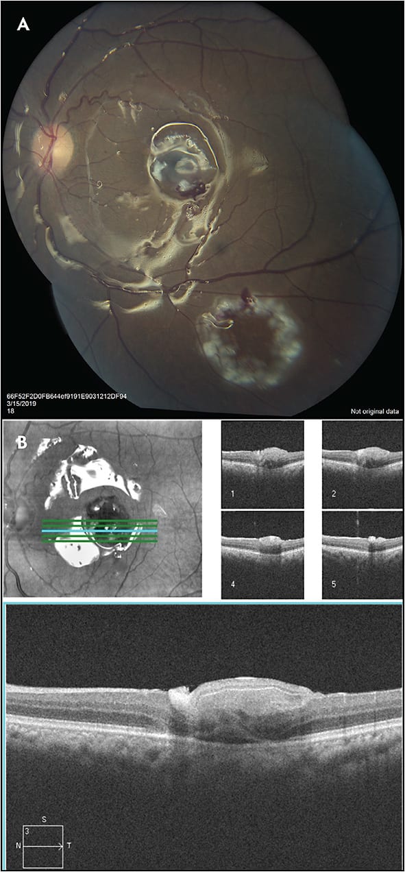 Figure 2. Fundus photo (A) and OCT (B) 1 day after retinal patch graft surgery in a 64-year-old male.