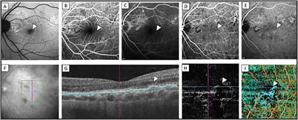 Figure 2. Left eye of a 53-year-old man with a history of bilateral CSC presented with a shallow pigment epithelial detachment (PED) and subfoveal choroidal thickness of 357 μm. Fundus autofluorescence (FAF) showed multiple patches of hyperautofluorescence (A). Early-phase fluorescein angiography (FA) (B) followed by late-phase FA (C) did not show any leakage other than transmission defect corresponding to the patches of hyperautofluorescence on FAF. Indocyanine green angiography (ICGA) in the early phase showed hyperfluorescence that corresponded with the transmission defect on FA (D). A hyperfluorescenct plaque appeared in the late ICGA phase (arrowhead). Based on the dye-based FA and ICGA findings, it was determined there was an absence of neovascularization associated with the PED (E). 3 mm x 3 mm en face OCTA scan area (green box) and crosshairs (purple and blue lines) overlaid on the black and white fundus photo (F). The segmentation slab (blue lines) was placed according to the outline of the PED on OCT B-scan (G). En face OCTA revealed a flow signal from a neovascular network in the outer retina, which was an incidental finding of a nonexudative type 1 CNV (H). The projection resolved algorithm coded the neovascular network in blue color (I). The patient was asymptomatic and did not receive treatment.