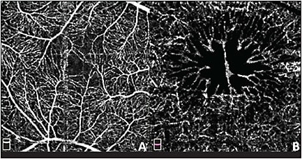 Figure 3. Optical coherence tomography angiography image 3 mm x 3 mm from the right eye of patient 3. A small distorted foveal avascular zone in the superficial retina (A). Cystic cavities are delineated by hyperreflective vessels in petaloid pattern the deep retina (B).