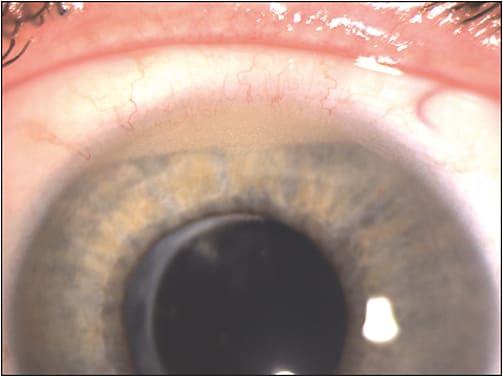 Figure 2. Emulsified silicone oil bubbles in the superior anterior chamber (hyperoleon).