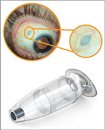 Figure 1. The PDS implant in position, viewed externally (top). The small circular silicone septum can be seen with magnification. A close-up of the implant is shown in the bottom image.