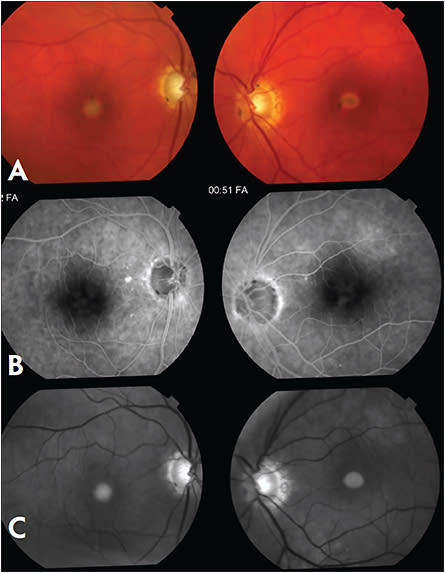 Figure 3. This 85-year-old, glaucomatous female was referred with a one-month history of bilateral blurring of central vision. VA measured 20/200 RE and 20/30 LE and fundus examination revealed bilateral yellow foveal lesions with pigment clumping (Figure A). FA demonstrated central blocking defects in early frames without staining or leakage (Figure B). Red-free photographs provided great contrast of the lesions (Figure C). Her findings and symptoms were consistent with adult-onset foveomacular vitelliform dystrophy.