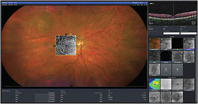 The IDI display showing results in a case of branch retinal vein occlusion.
IMAGE COURTESY OF ZEISS