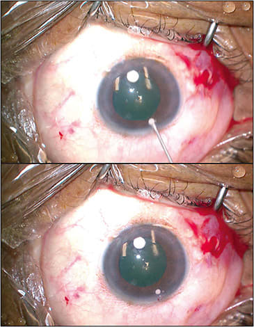 Figure 2. In a phakic patient undergoing vitreoretinal surgery, a syringe loaded with intracameral dexamethasone and capped with a 27-gauge short needle is inserted directly into the anterior chamber and injected under the iris (A). Residual intracameral dexamethasone in the anterior chamber (B) tends to dissolve within 14 days.