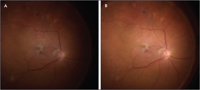 Figure 3.  The illumination before the DORC EVA upgrade, with an older LED module and 27-gauge fiber (A), and after the DORC EVA upgrade, with an upgraded LED module and an enhanced 27-gauge fiber (B).