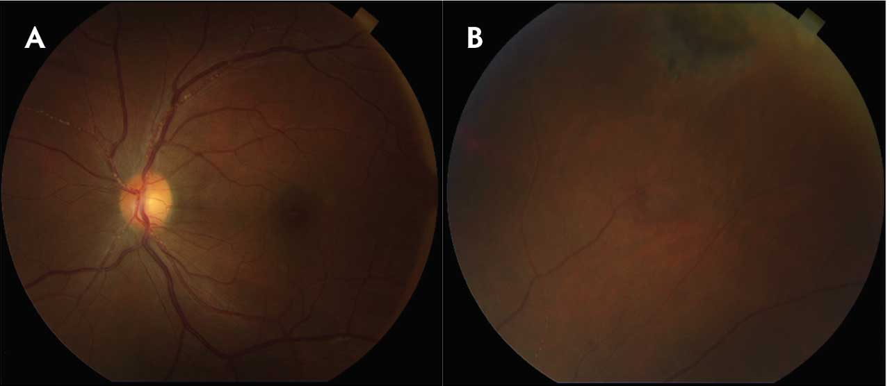 Figure 1.  Color fundus photo of left eye depicting Kyrieleis arterial plaques (A) in a patient with human immunodeficiency virus and syphilitic chorioretinitis after treatment with intravenous penicillin (B).