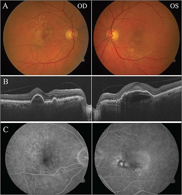 Figure 1. A 76-year-old female with nAMD with PED OU. BCVA was 20/30 OD and 20/100 OS, and fundus photos demonstrated multiple drusen with PEDs OU (A). SD-OCT showed large drusenoid PEDs with OS being worse than OD (B). FA showed late staining of multiple drusen and subtle staining of a large drusenoid PED without leakage OD (C, left). OS demonstrated an area of stippled and poorly defined leakage within area of the large PED centrally and superotemporally to the fovea (C, right).