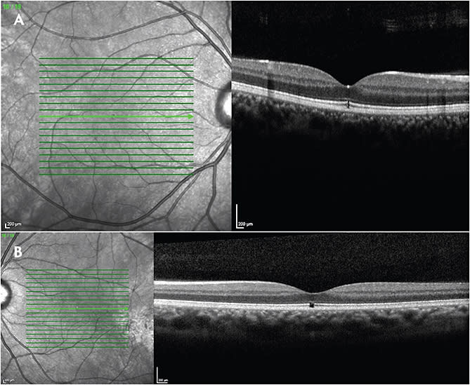 Figure 2. Solar retinopathy. This 23-year-old male had a history of psychiatric disease and sun gazing. Spectral-domain optical coherence tomography (A, B) shows bilateral focal outer retinal atrophy consistent with solar retinopathy.
IMAGES COURTESY OF JAYANTH SRIDHAR, MD.