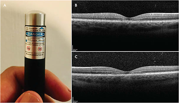 Figure 3. Laser-induced retinopathy. This 13-year old female with a history of anxiety, depression, and self-harming behavior noted bilateral central vision loss after looking directly at a laser pointer (A) while listening to music in her bedroom. Optical coherence tomography (B, C) demonstrates bilateral focal outer retinal disruption.